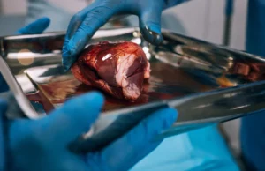 Cerca de metade dos pacientes transplantados renais nunca iniciam