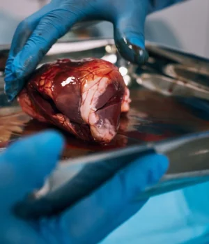 hospital-doctors-organ-transplant-surgery.webp