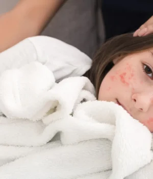 mother-holding-girl-with-measles.webp