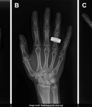 t7f2fbfs_xray_625x300_15_July_26.jpeg