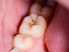 Adeus, buraco? O novo gel pode regenerar o esmalte dos dentes