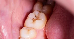 Adeus, buraco? O novo gel pode regenerar o esmalte dos dentes