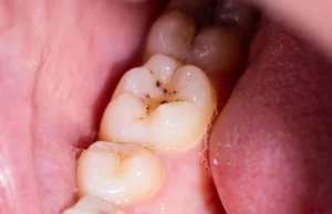Adeus, buraco? O novo gel pode regenerar o esmalte dos dentes