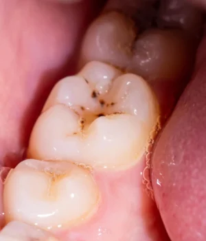 teeth-dental-cavities-mouth-tongue.webp