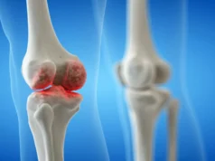A osteoartrite do joelho não é inevitável – isto é o que você pode fazer