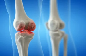 A osteoartrite do joelho não é inevitável – isto é o que você pode fazer