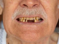 Contagem de dentes pode prever sobrevivência após cirurgia de câncer de pâncreas