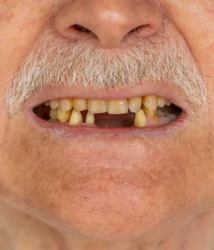 senior-man-missing-teeth.webp