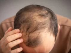 Ozempic e Vegovy podem aumentar o risco de queda de cabelo em alguns homens
