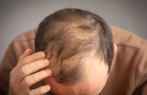 Ozempic e Vegovy podem aumentar o risco de queda de cabelo em alguns homens