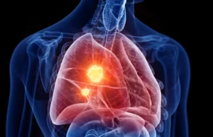 Novo medicamento para mesotelioma altera sua própria defesa contra o câncer