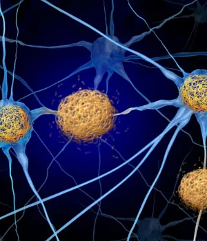 tau-tangles-amyloid-beta-neuron-cells-in-brain-alzheimers-dementia.webp