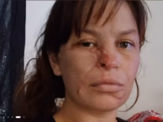 Mulher desfigurada por ataque de pit bull enquanto grávida de gêmeos diz que está farta de olhares constantes de estranhos