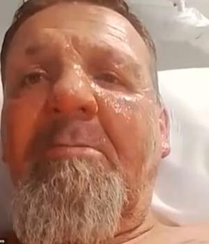 111850889-16207893-Randovan_Banic_54_who_suffered_serious_facial_and_upper_body_bur-m-37_17919717812.avif